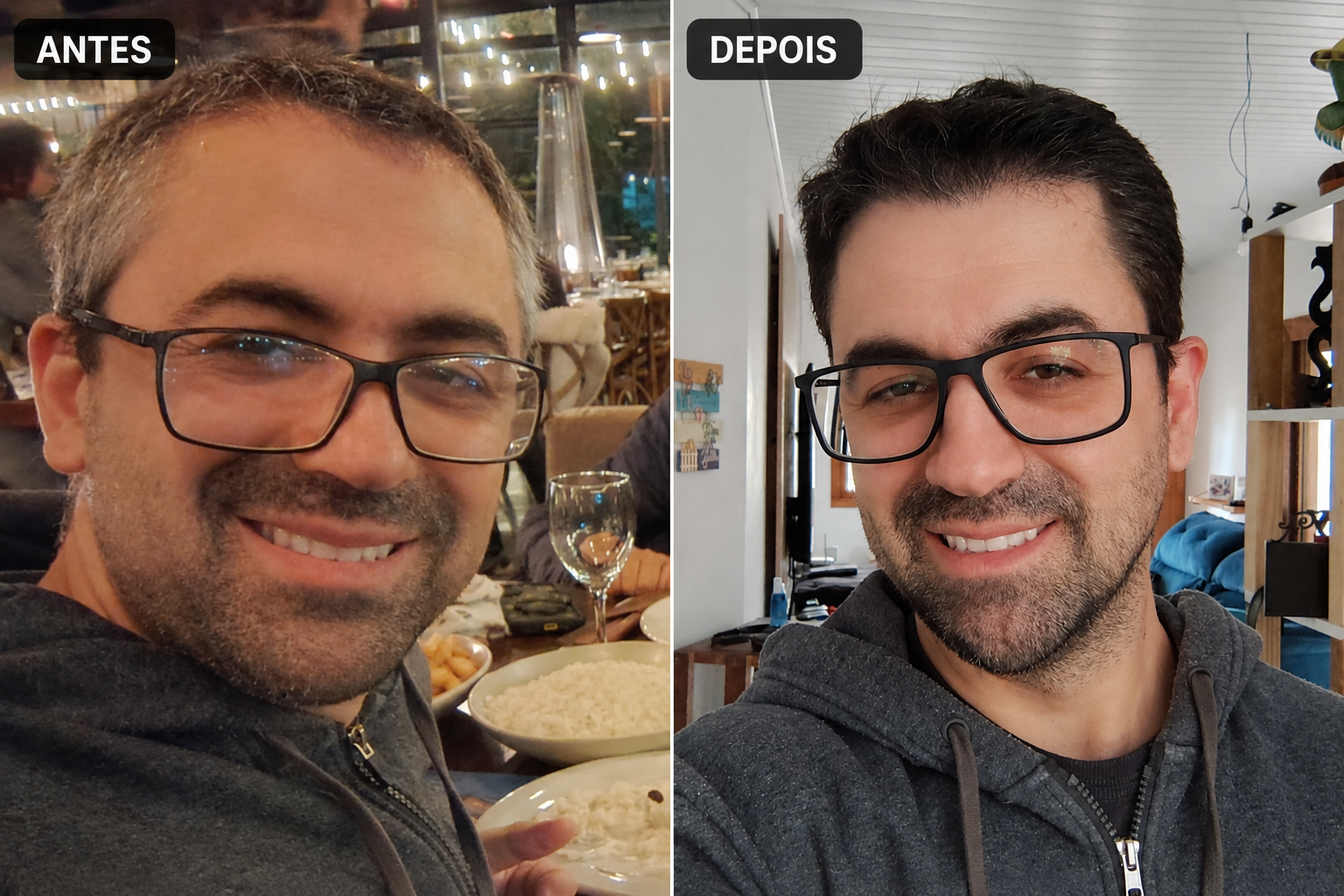 Antes e depois — paciente 1, resultado 6 meses após transplante capilar de alta densidade