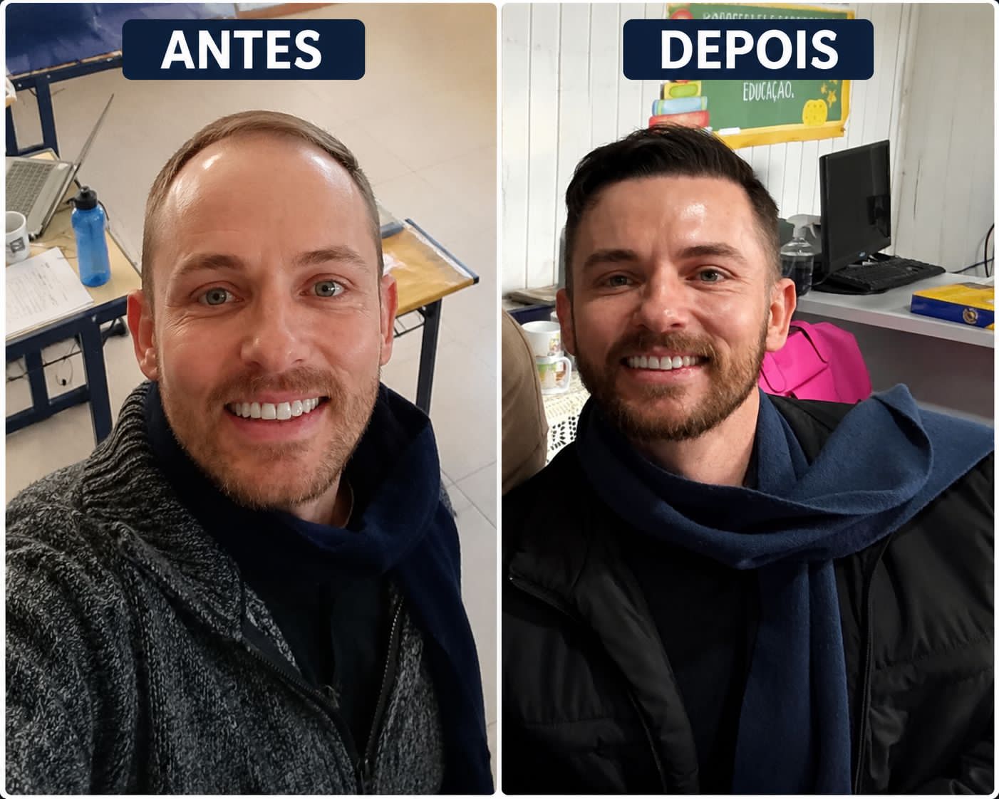 Antes e depois — paciente 2, resultado 6 meses após transplante capilar de alta densidade